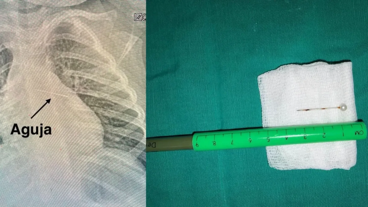 Beba de 2 añitos aspiró un alfiler y terminó clavado en sus bronquios